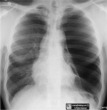 Vanishing Lung Syndrome
